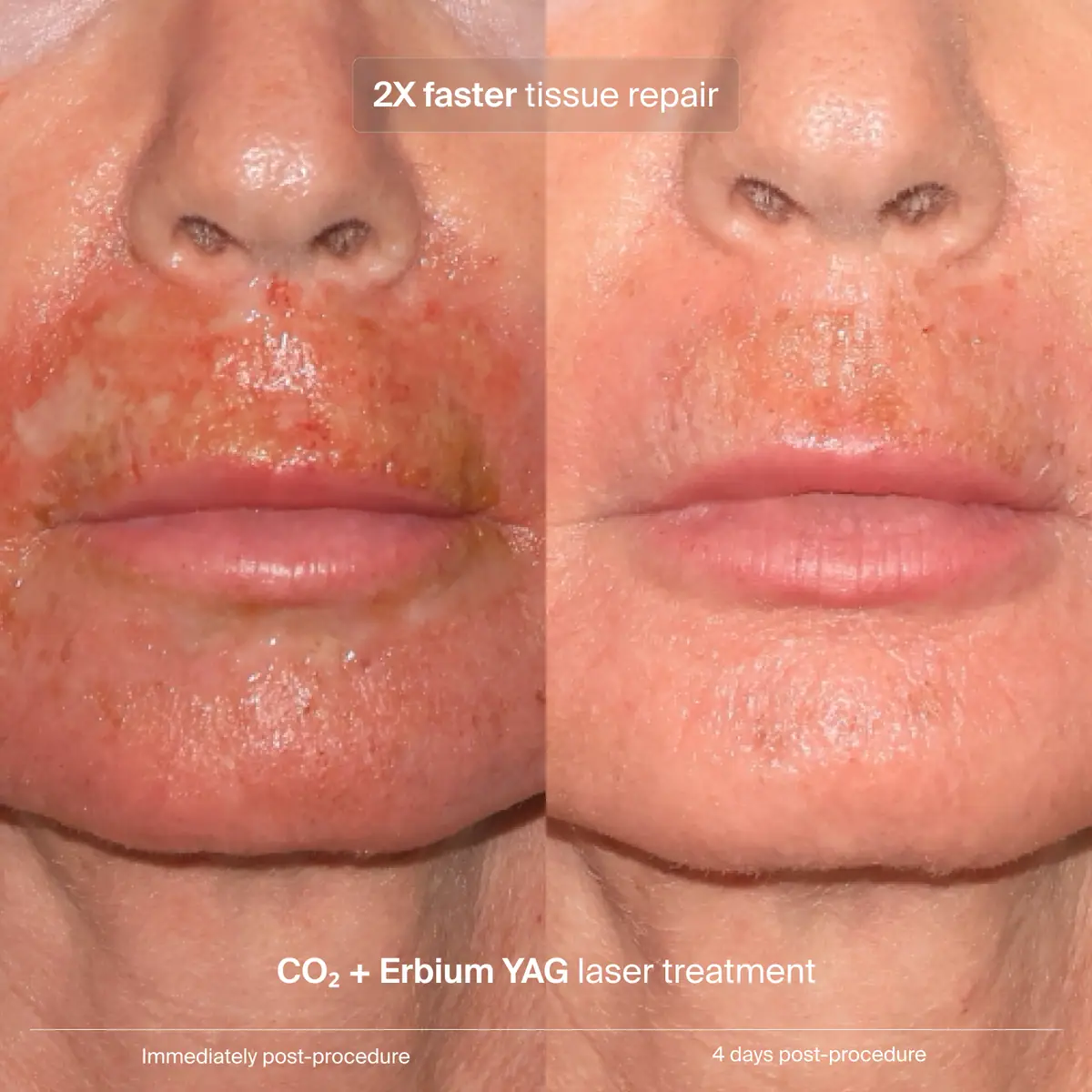 PAVISE Extracellular Matrix Restore