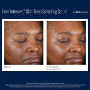 SkinBetter Even Intensive Skin Tone Correcting Serum - Brightening + Hydration for Uneven Skin Tone