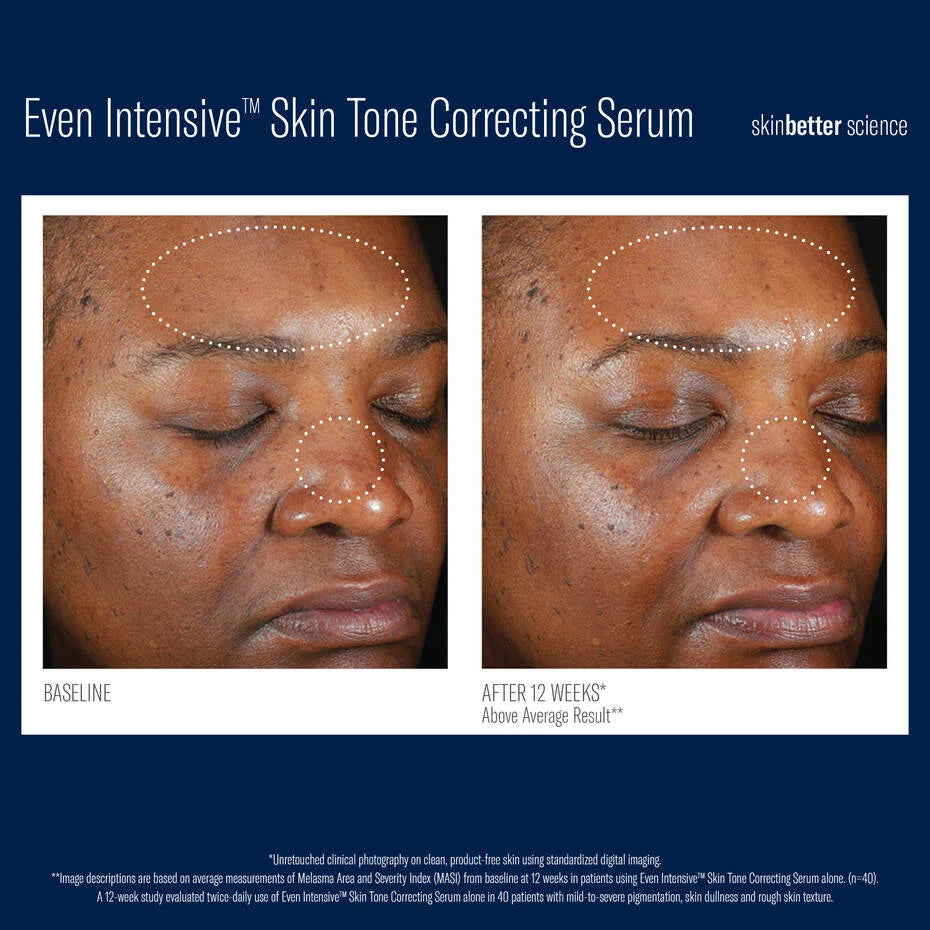SkinBetter Even Intensive Skin Tone Correcting Serum - Brightening + Hydration for Uneven Skin Tone