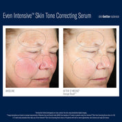SkinBetter Even Intensive Skin Tone Correcting Serum - Brightening + Hydration for Uneven Skin Tone