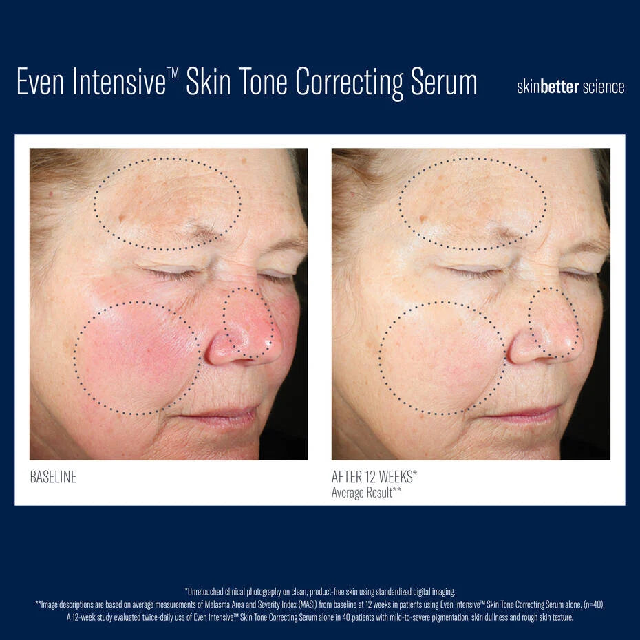 SkinBetter Even Intensive Skin Tone Correcting Serum - Brightening + Hydration for Uneven Skin Tone