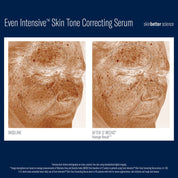 SkinBetter Even Intensive Skin Tone Correcting Serum - Brightening + Hydration for Uneven Skin Tone