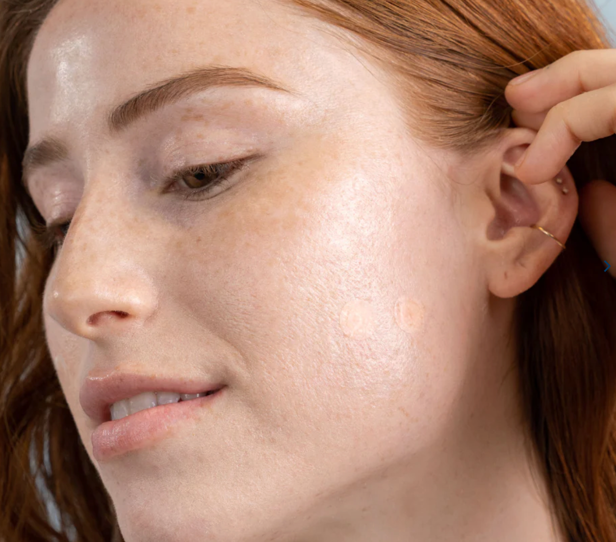 DermaDot Invisible Pimple Patches (60 Patches) - bespøke by SKINALCHEMY